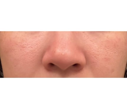 DETクリア ブライト&ピール ピーリングジェリー<ミックスフルーツの香り>/Detclear/ピーリングを使ったクチコミ(1枚目)