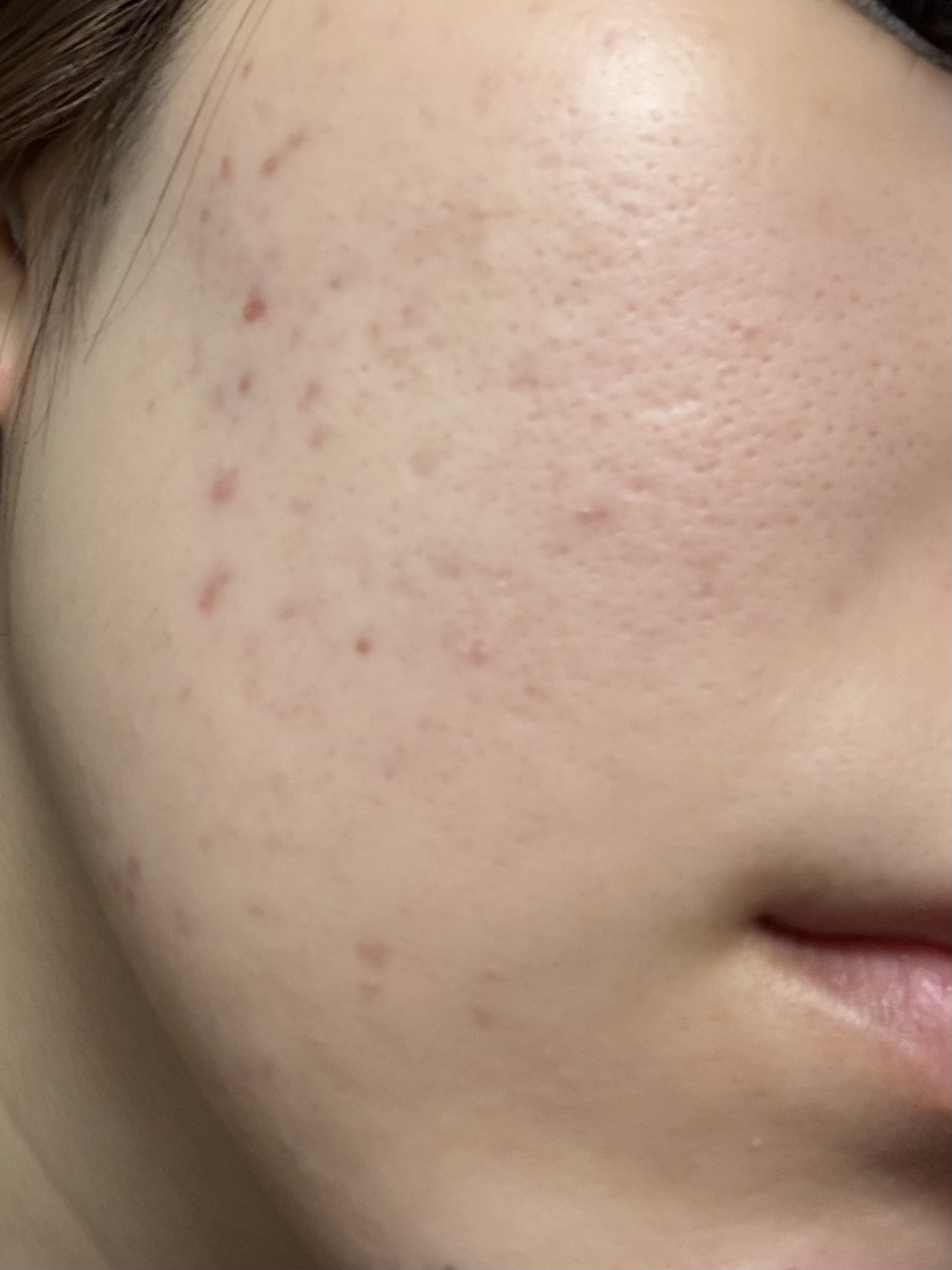 潤浸保湿 化粧水 III とてもしっとり/キュレル/化粧水を使ったクチコミ（2枚目）