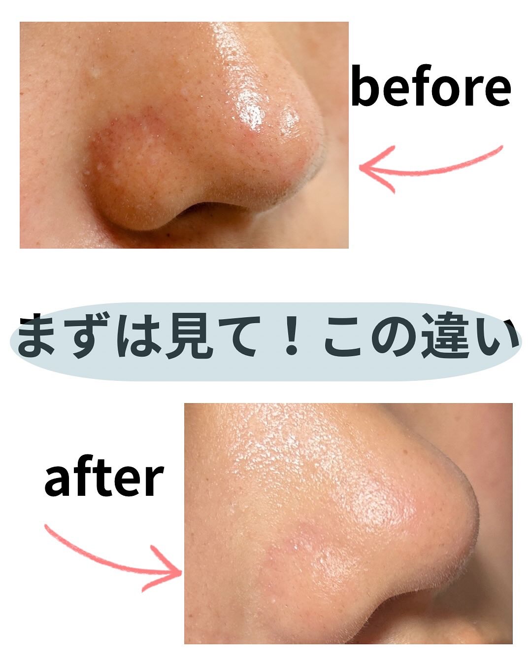 ナチュラルマイルドクリアノーズパック/ilso/シートマスク・パックを使ったクチコミ（3枚目）