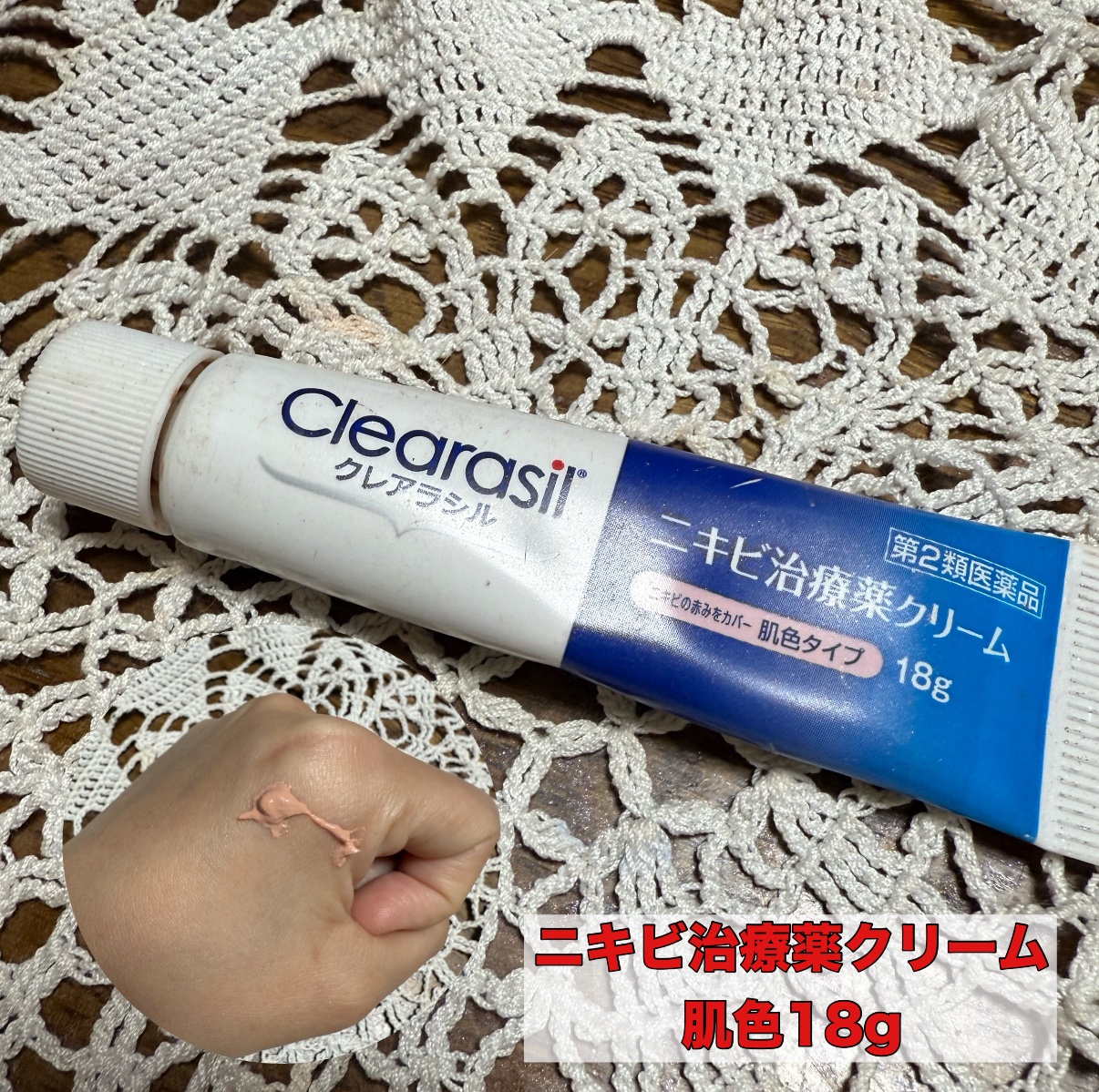 ニキビ治療薬クリーム (医薬品) 肌色/クレアラシル/その他を使ったクチコミ（1枚目）