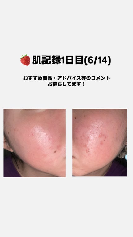 パーフェクトホイップ アクネケア/SENKA(専科)/洗顔フォームを使ったクチコミ(1枚目)