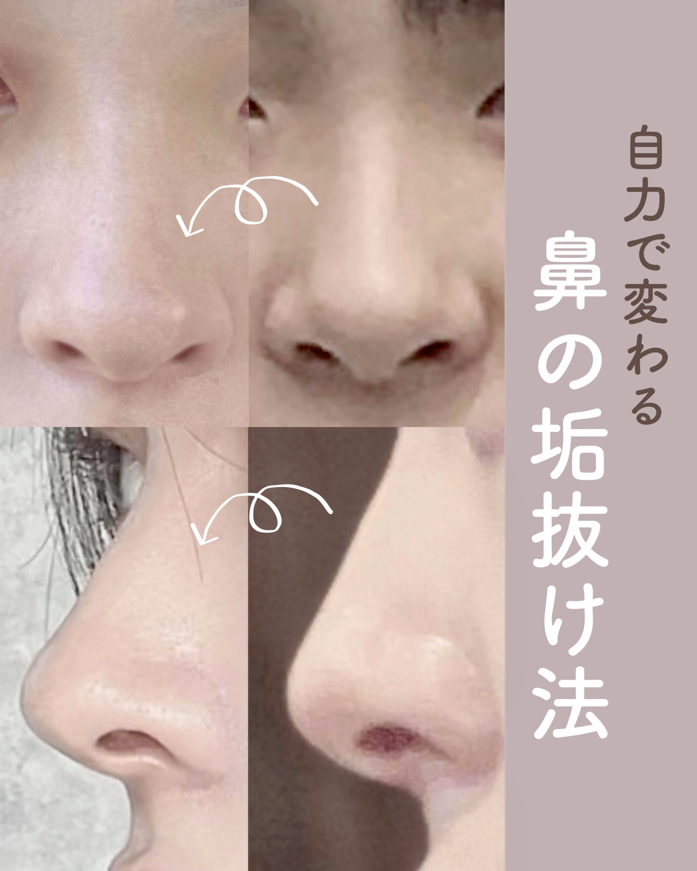 お鼻リフォーマー ハナハナ/グッズマン/その他を使ったクチコミ（1枚目）