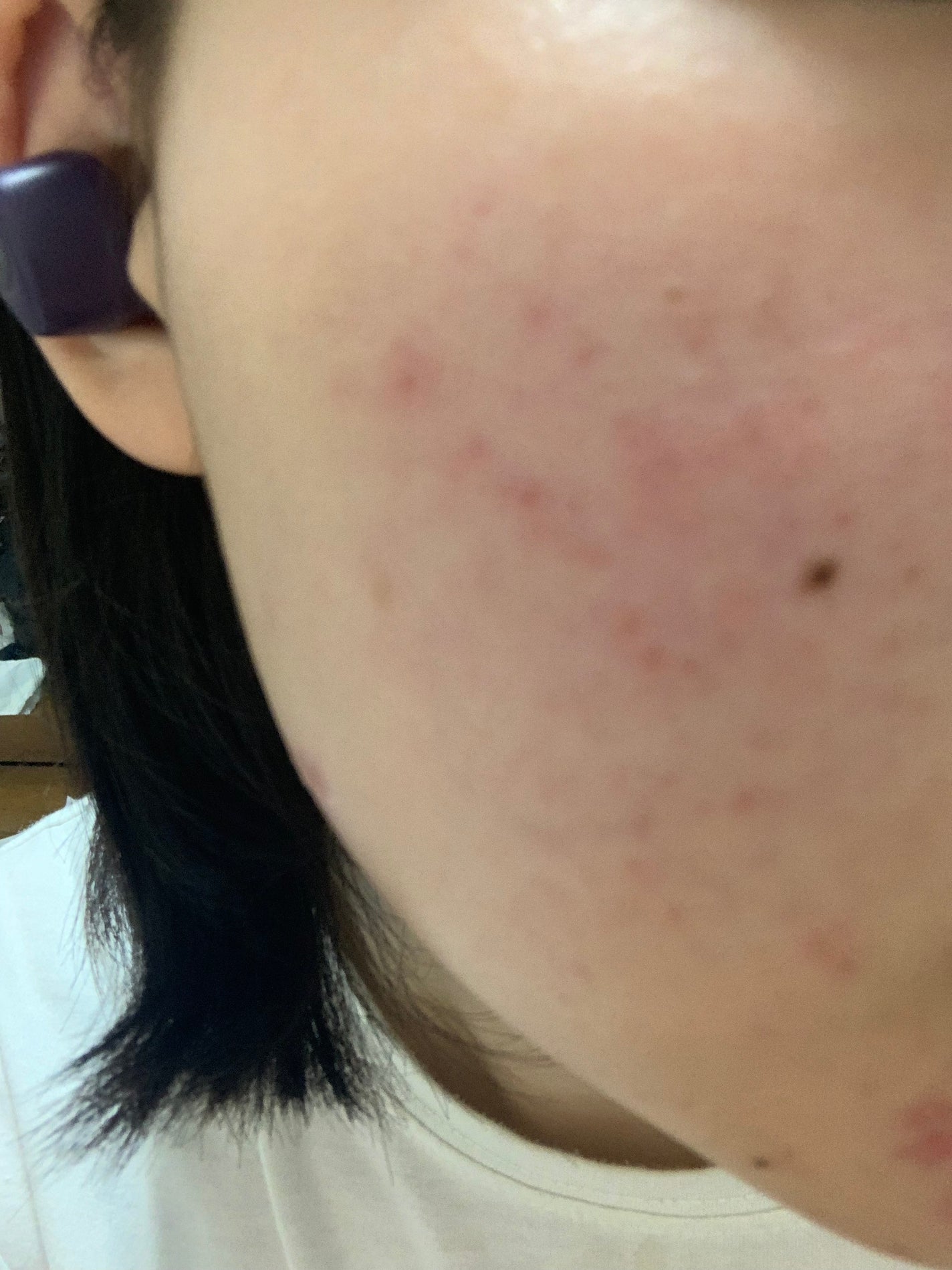 さく on LIPS 「今日のお肌✨#JK#垢抜け #肌改善 #スキンケア #ニキビ ..」(2枚目)