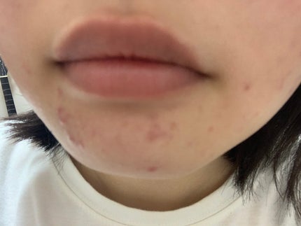 さく on LIPS 「今日のお肌✨#JK#垢抜け #肌改善 #スキンケア #ニキビ ..」(4枚目)