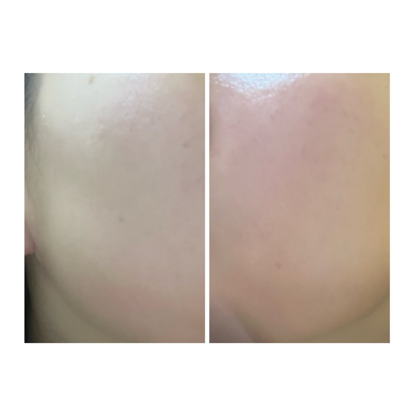 ぽむ on LIPS 「2023.9.13皮膚科に受診 エピデュオとヘパリン処方1枚目..」(5枚目)