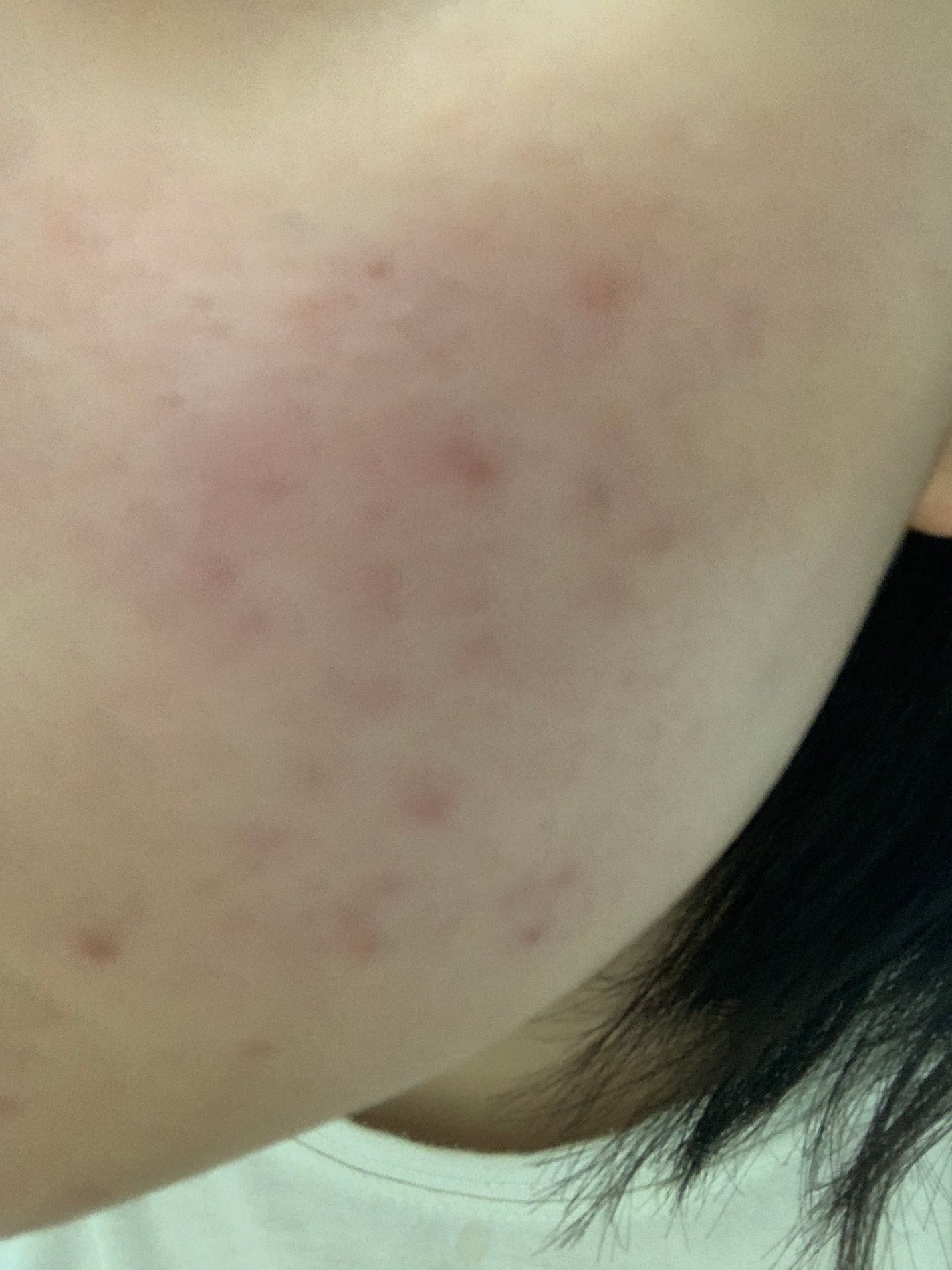 さく on LIPS 「今日のお肌✨#JK#垢抜け #肌改善 #スキンケア #ニキビ ..」(3枚目)