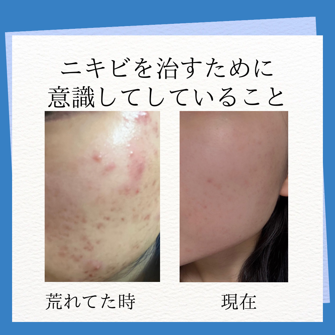 薬用しみ集中対策 プレミアム美容液/メラノCC/美容液を使ったクチコミ（1枚目）