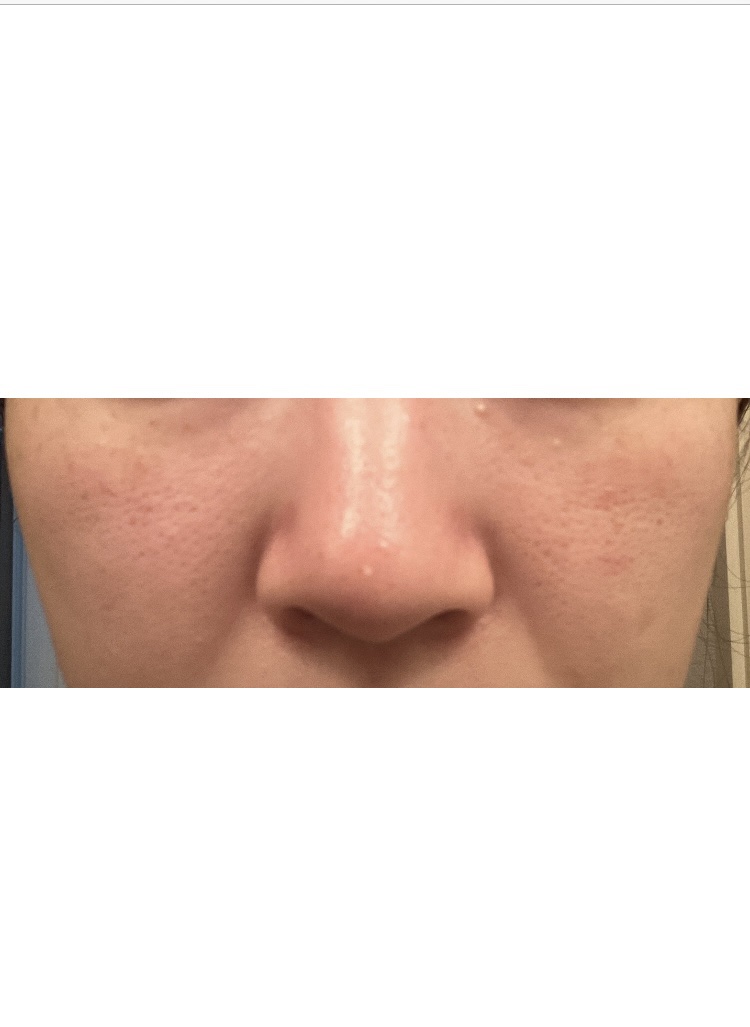 薬用クリアケア乳液 携帯用（50ml）/無印良品/乳液を使ったクチコミ（1枚目）