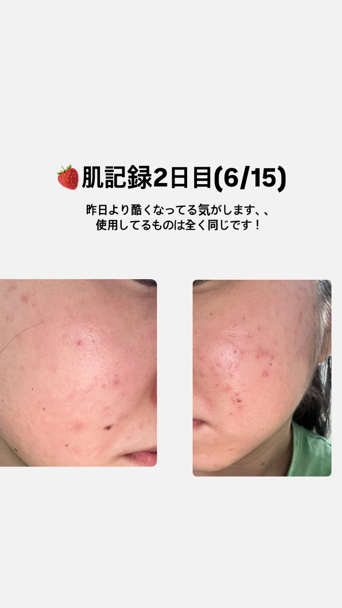 ♡ on LIPS 「肌記録2日目です!!昨日よりも赤いポツポツしたのが増えてる気が..」(1枚目)