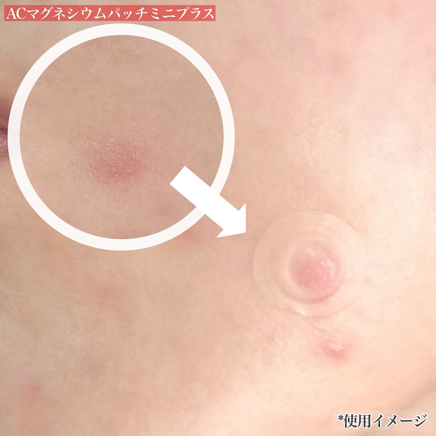 ACマグネシウムパッチ/スノーツープラス/シートマスク・パックを使ったクチコミ(5枚目)