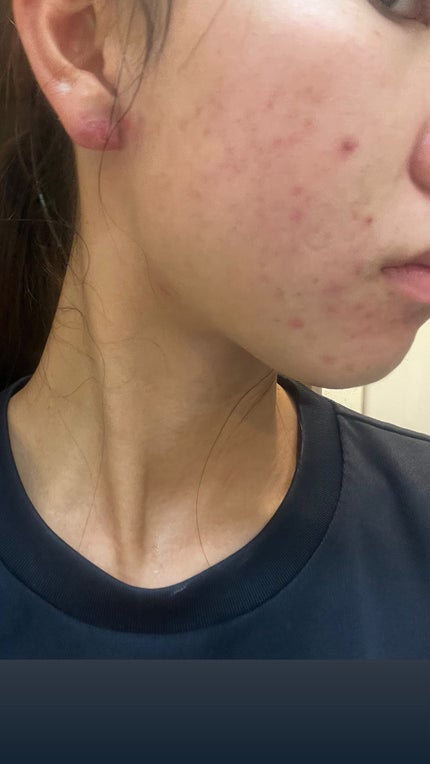 も on LIPS 「顎がマシになっている。飲み薬たちがきれて、最近あまり飲んでいな..」(4枚目)