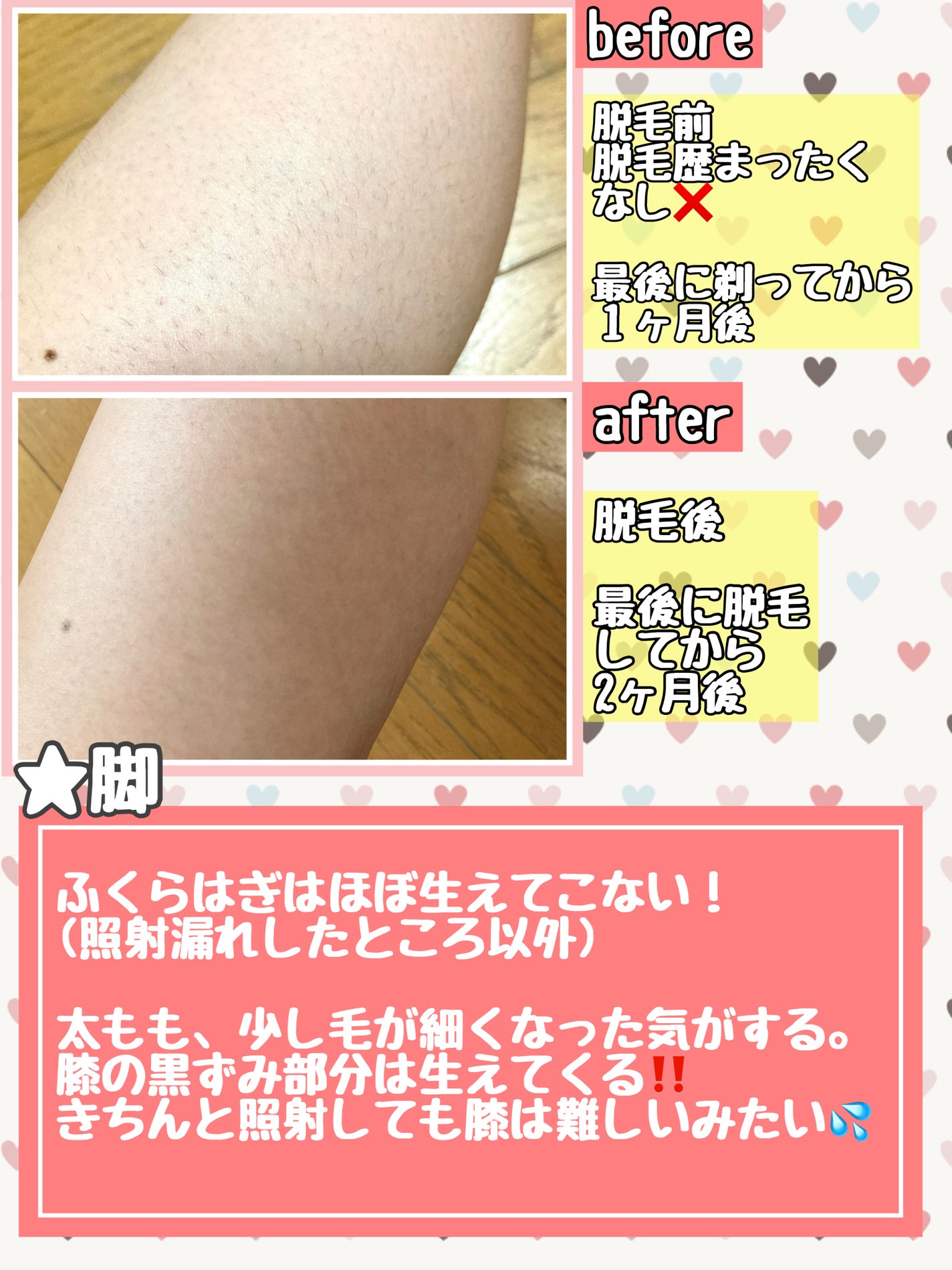 BRAUN シルクエキスパート/ブラウン/家庭用脱毛器を使ったクチコミ(5枚目)