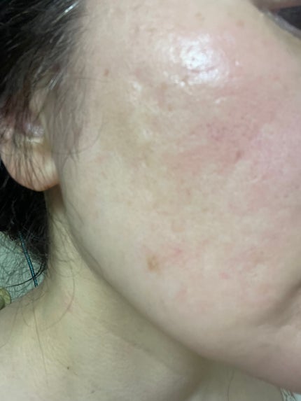 リードルS PDRN+ マスク/VT/シートマスク・パックを使ったクチコミ(6枚目)