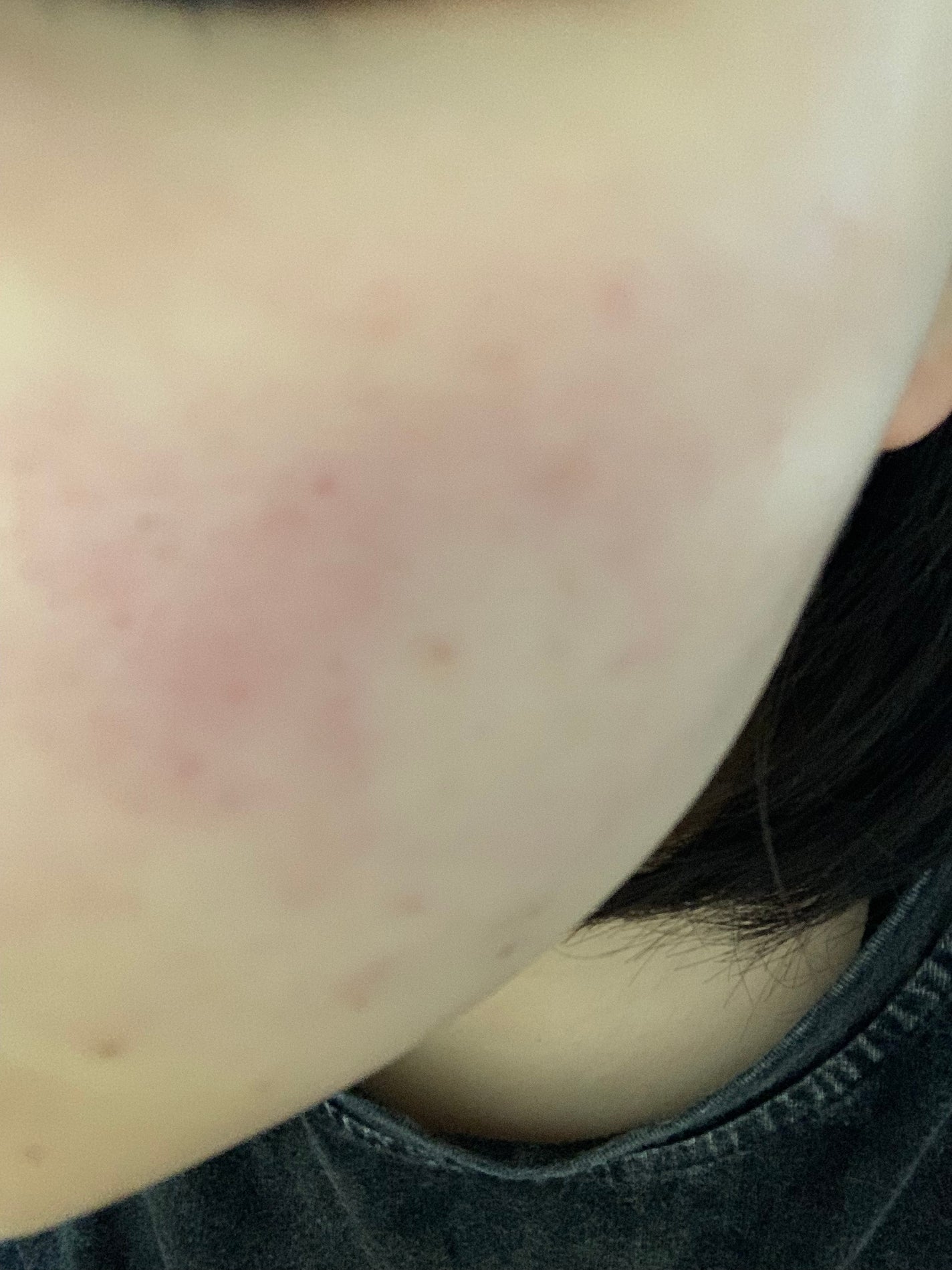 さく on LIPS 「今日のお肌✨本当にすごく改善傾向 女の子の日前なので顎ニキビは..」(2枚目)