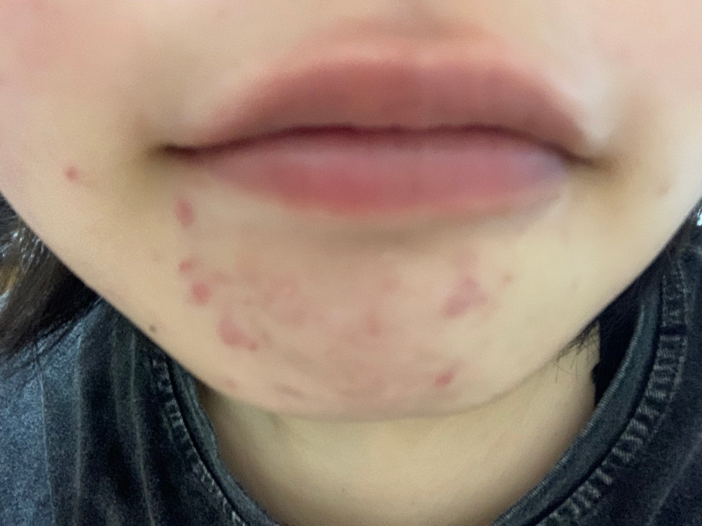 さく on LIPS 「今日のお肌✨本当にすごく改善傾向 女の子の日前なので顎ニキビは..」(4枚目)