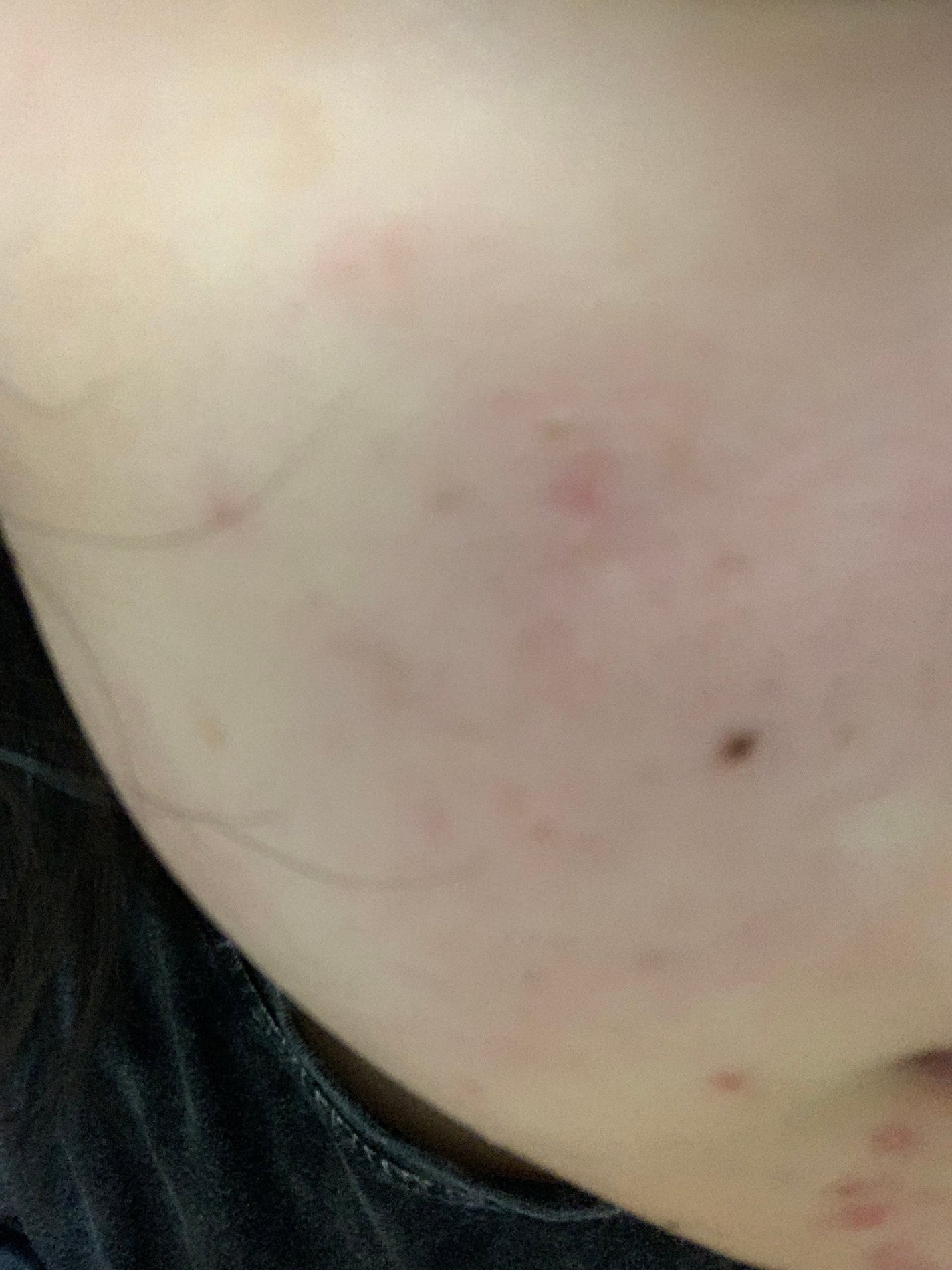 さく on LIPS 「今日のお肌✨本当にすごく改善傾向 女の子の日前なので顎ニキビは..」(3枚目)