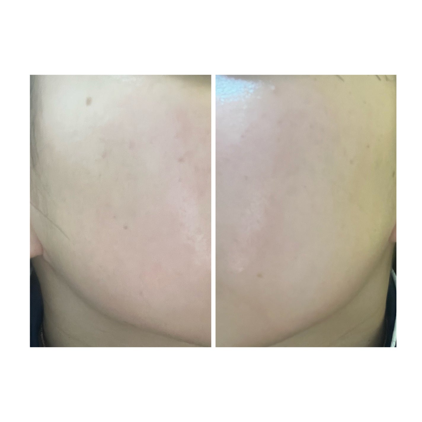 ぽむ on LIPS 「2023.9.13皮膚科に受診 エピデュオとヘパリン処方1枚目..」(3枚目)