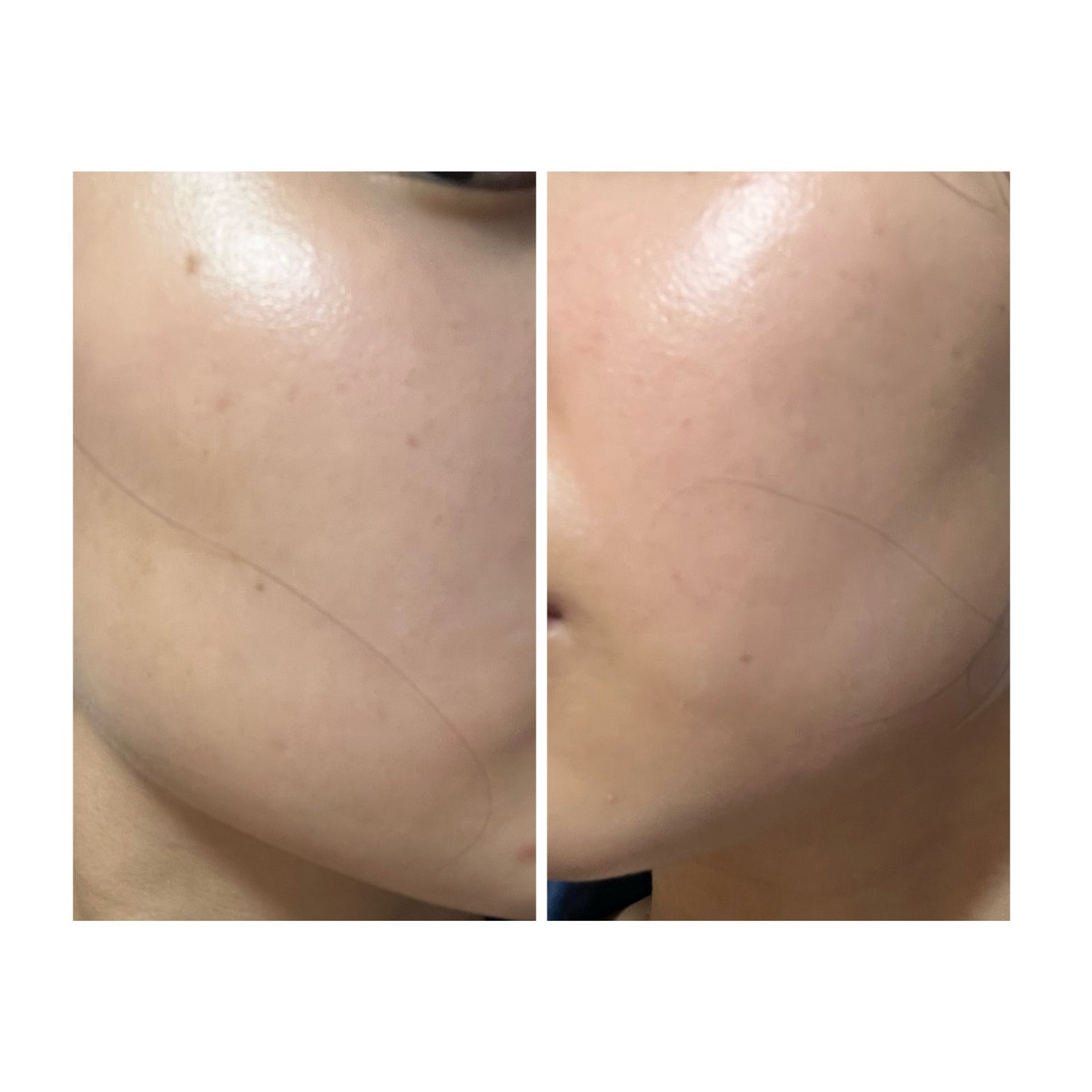 ぽむ on LIPS 「2023.9.13皮膚科に受診 エピデュオとヘパリン処方1枚目..」(1枚目)