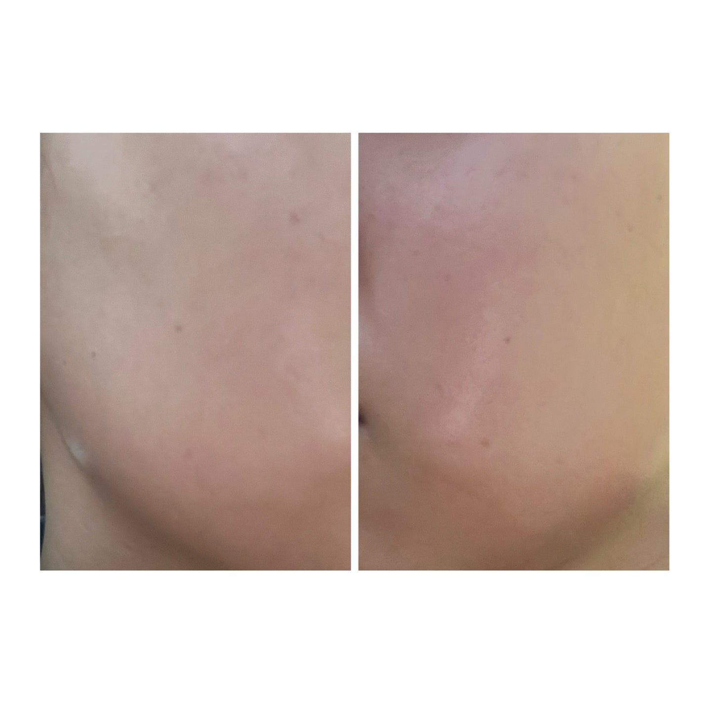 ぽむ on LIPS 「2023.9.13皮膚科に受診 エピデュオとヘパリン処方1枚目..」(5枚目)