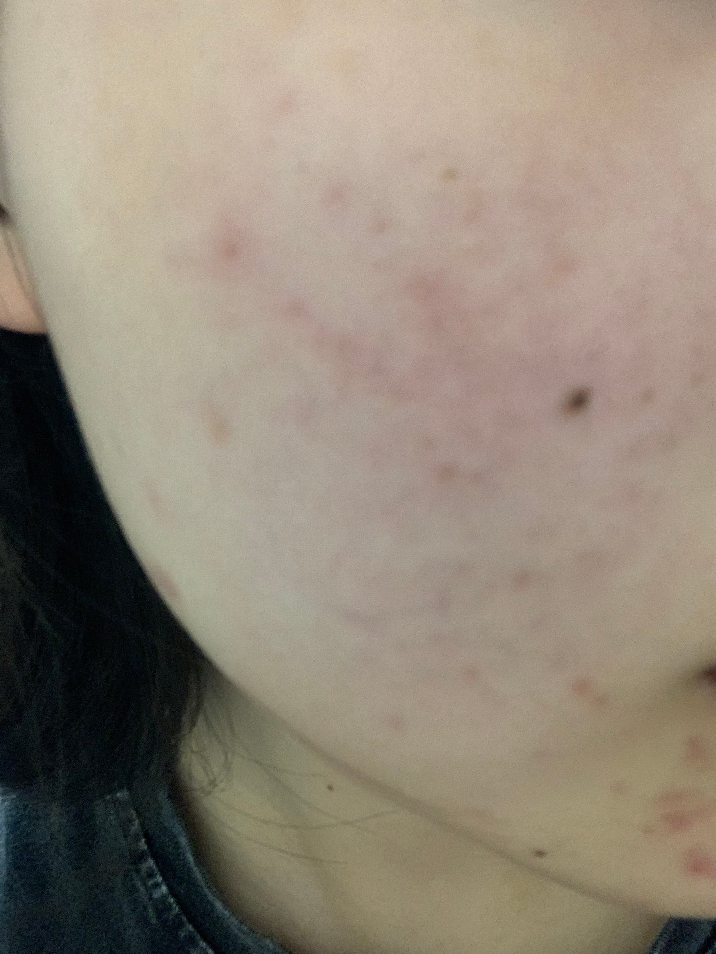 さく on LIPS 「今日のお肌✨この赤紫のニキビ跡どうにかなりませんか、、、頬の赤..」(3枚目)