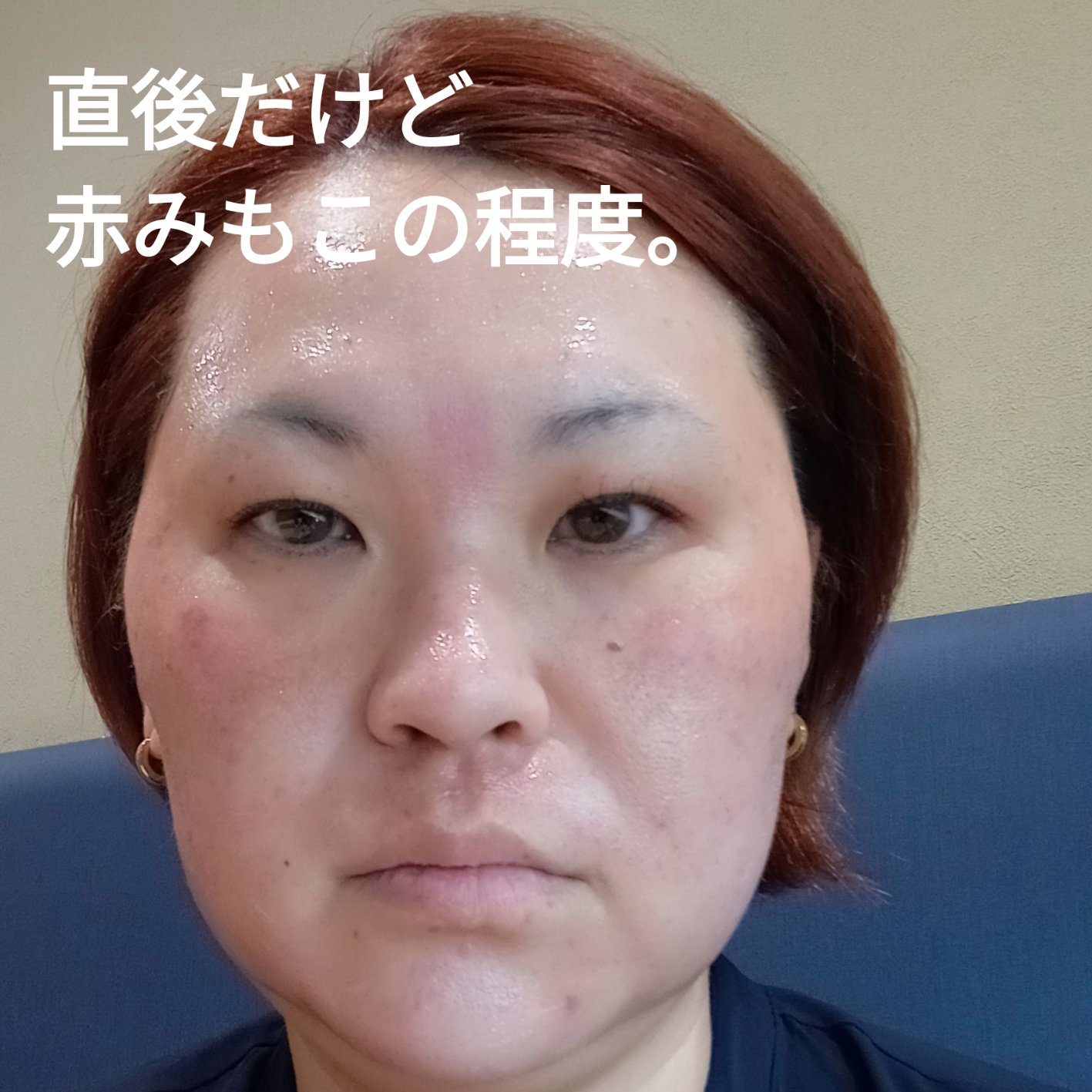 ダーマペン4/SBC/その他を使ったクチコミ（3枚目）