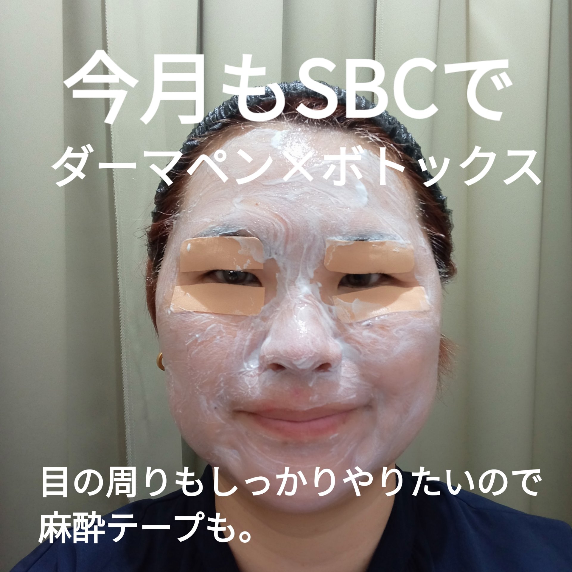 ダーマペン4/SBC/その他を使ったクチコミ（1枚目）