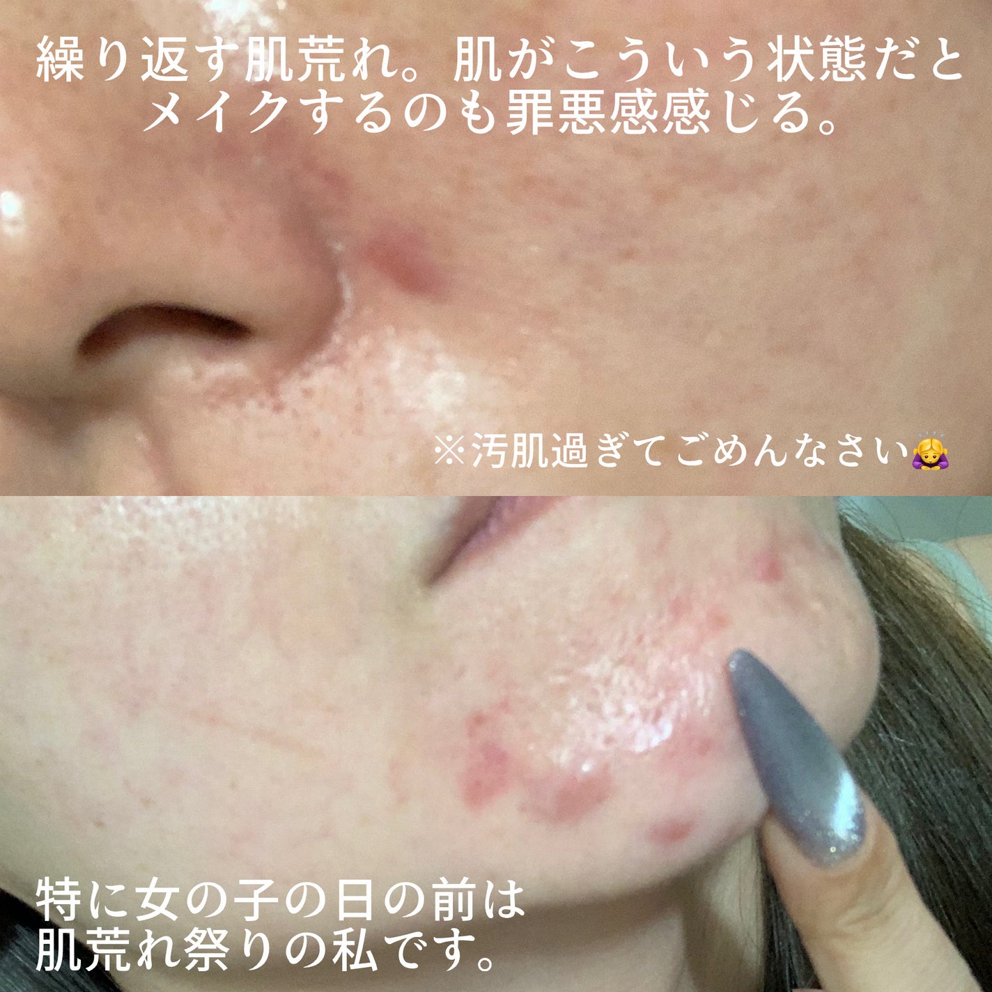 ダーマシンコンシーラー/23years old/リキッドコンシーラーを使ったクチコミ(2枚目)