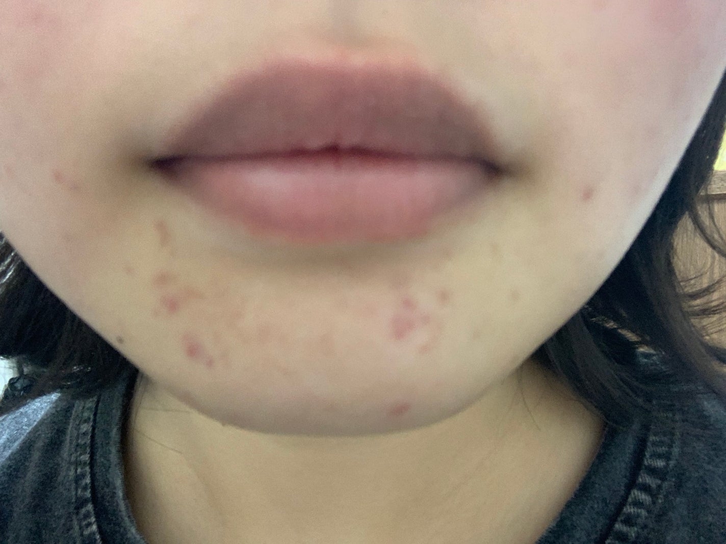 さく on LIPS 「今日のお肌✨この赤紫のニキビ跡どうにかなりませんか、、、頬の赤..」(4枚目)