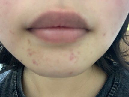 さく on LIPS 「今日のお肌✨この赤紫のニキビ跡どうにかなりませんか、、、頬の赤..」(4枚目)