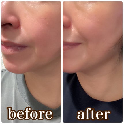 PDRN+リードルS 100/VT/美容液を使ったクチコミ(4枚目)