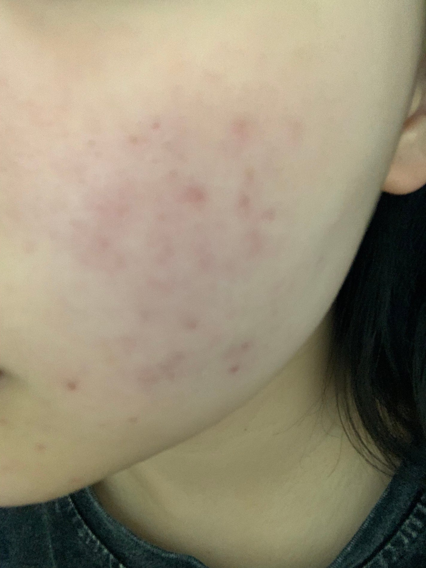 さく on LIPS 「今日のお肌✨この赤紫のニキビ跡どうにかなりませんか、、、頬の赤..」(2枚目)