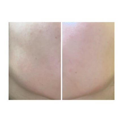 ぽむ on LIPS 「2023.9.13皮膚科に受診 エピデュオとヘパリン処方1枚目..」(1枚目)