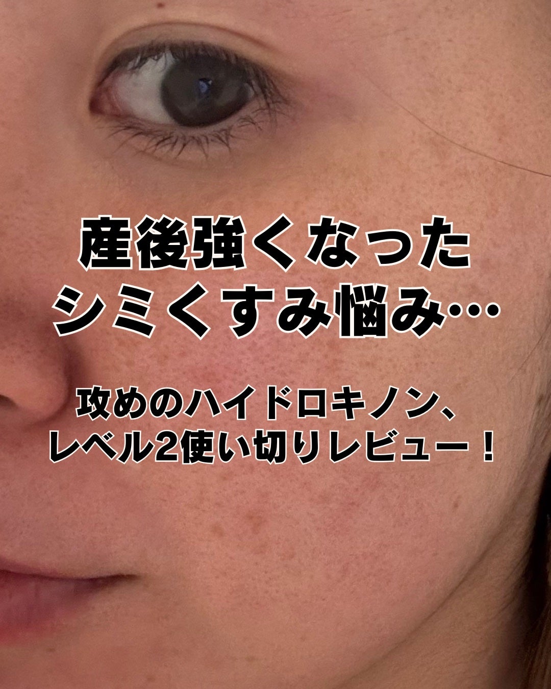 Latte|元BA on LIPS 「産後のシミくすみ、どうにかしたくて…/ビーグレンのクエスクHQ..」(2枚目)