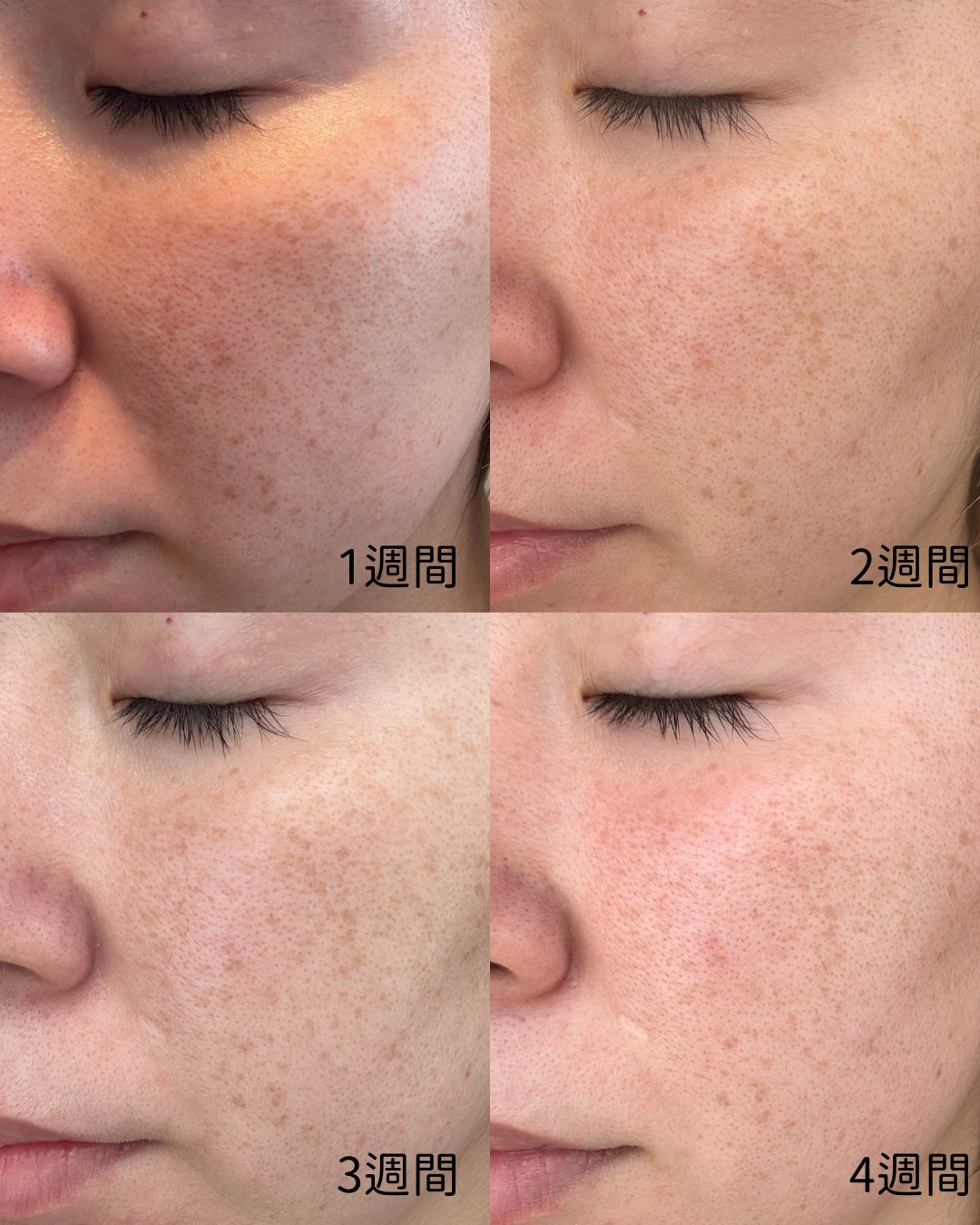 Latte|元BA on LIPS 「産後のシミくすみ、どうにかしたくて…/ビーグレンのクエスクHQ..」(5枚目)