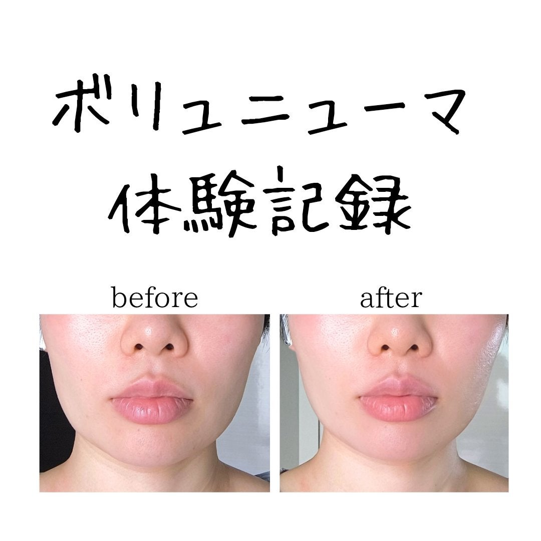 sukonbu@フォロ100 on LIPS 「最近輪郭がボヤケて来たので初ボリュニューマ体験しにいってきまし..」(1枚目)