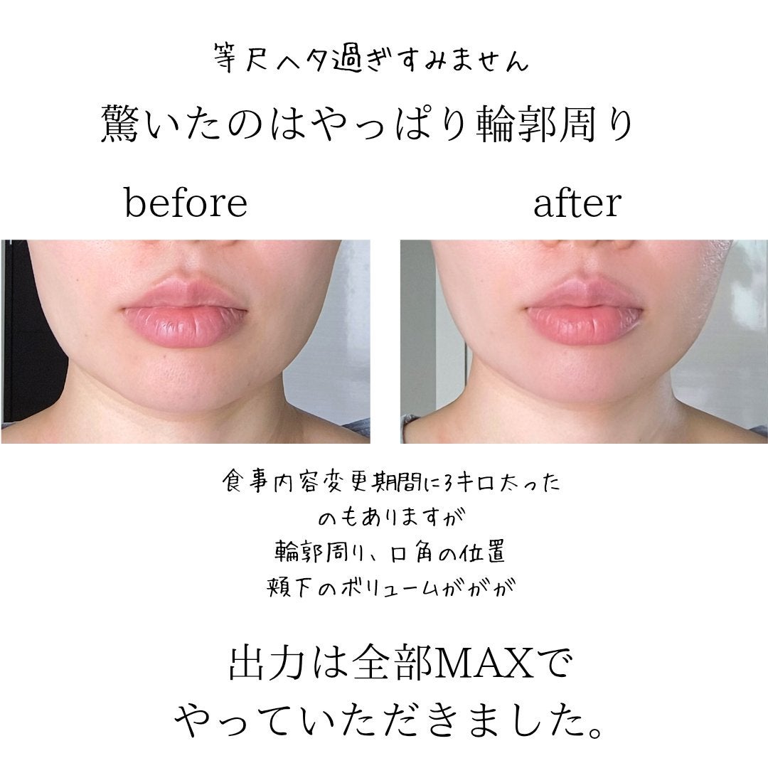 sukonbu@フォロ100 on LIPS 「最近輪郭がボヤケて来たので初ボリュニューマ体験しにいってきまし..」(2枚目)