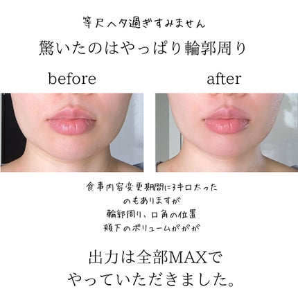 sukonbu@フォロ100 on LIPS 「最近輪郭がボヤケて来たので初ボリュニューマ体験しにいってきまし..」(2枚目)