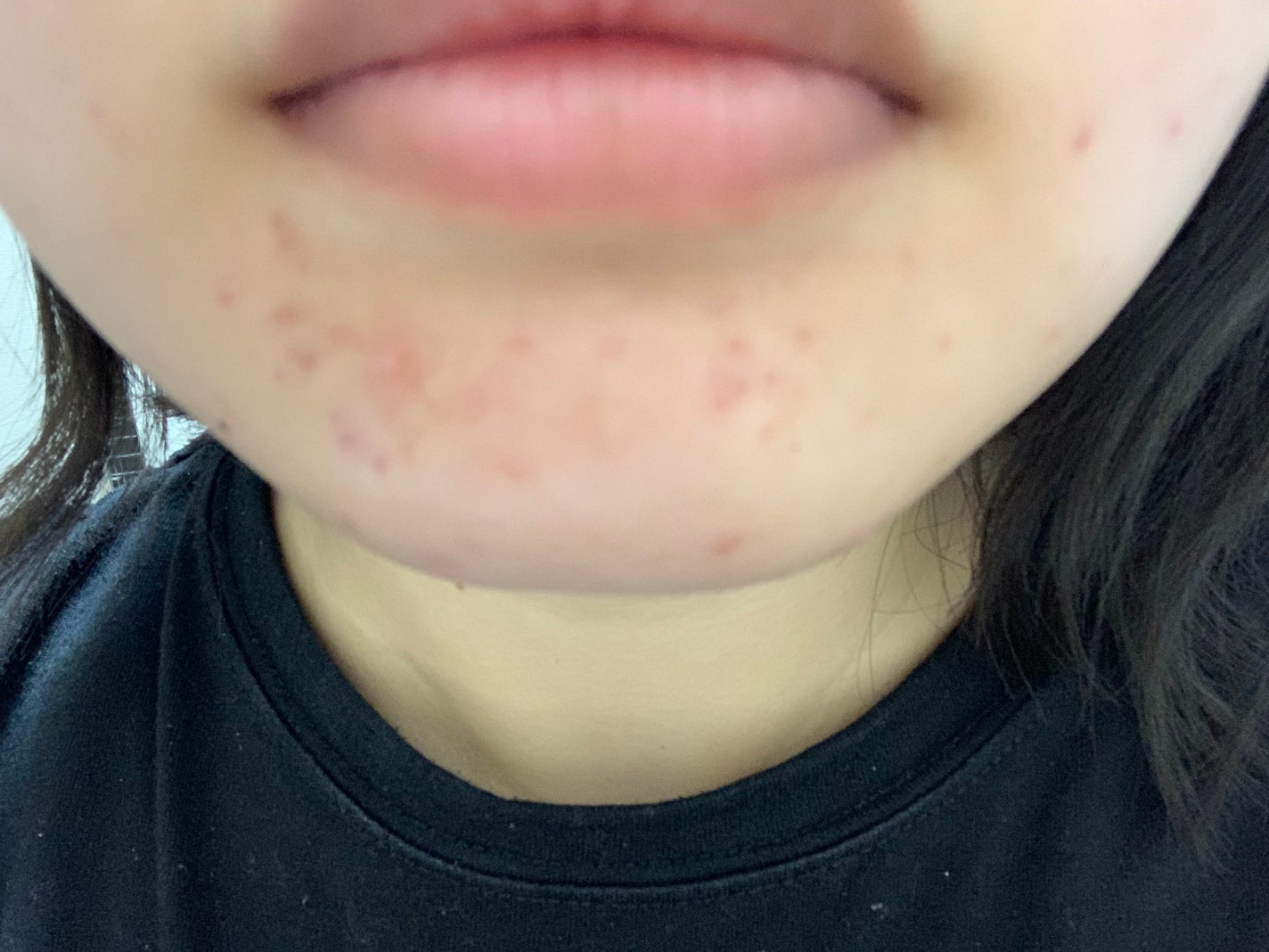 さく on LIPS 「今日のお肌✨やはりニキビ跡が気になる#JK#垢抜け #肌改善 ..」(4枚目)