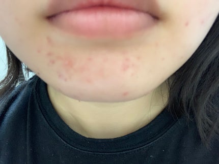 さく on LIPS 「今日のお肌✨やはりニキビ跡が気になる#JK#垢抜け #肌改善 ..」(4枚目)