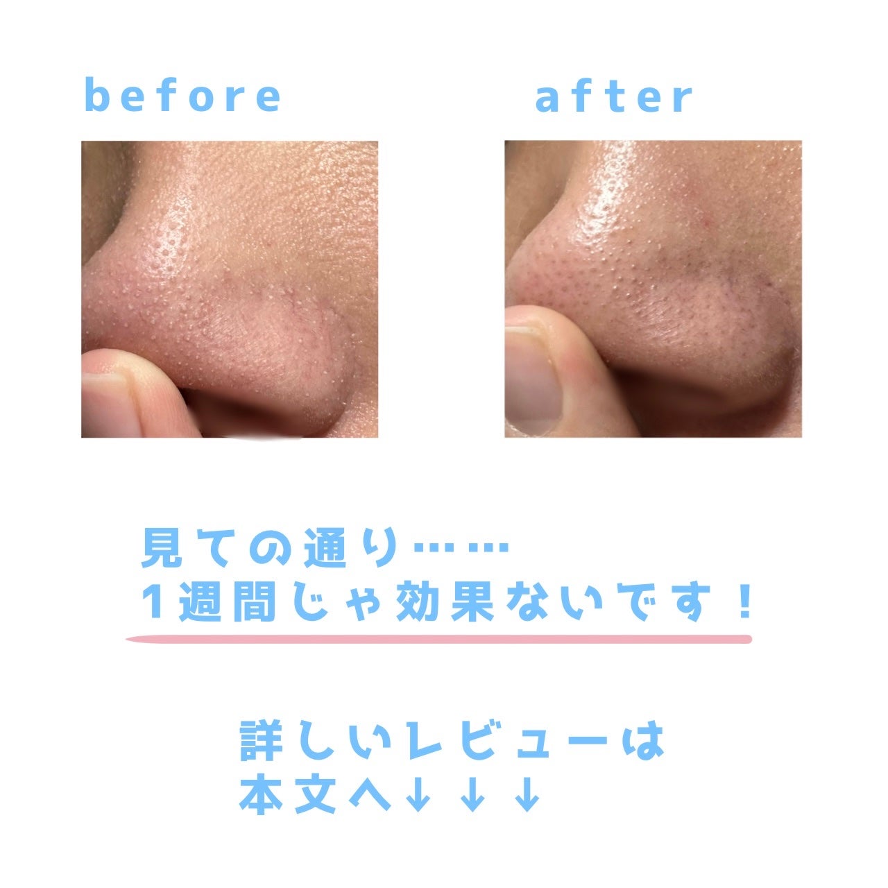 リポピールセラム/LIPOPEEL/美容液を使ったクチコミ(3枚目)