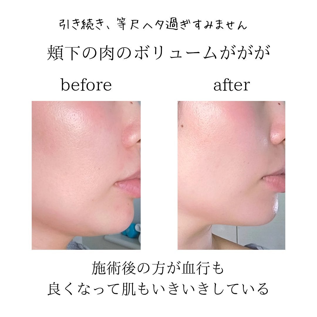 sukonbu@フォロ100 on LIPS 「最近輪郭がボヤケて来たので初ボリュニューマ体験しにいってきまし..」(3枚目)