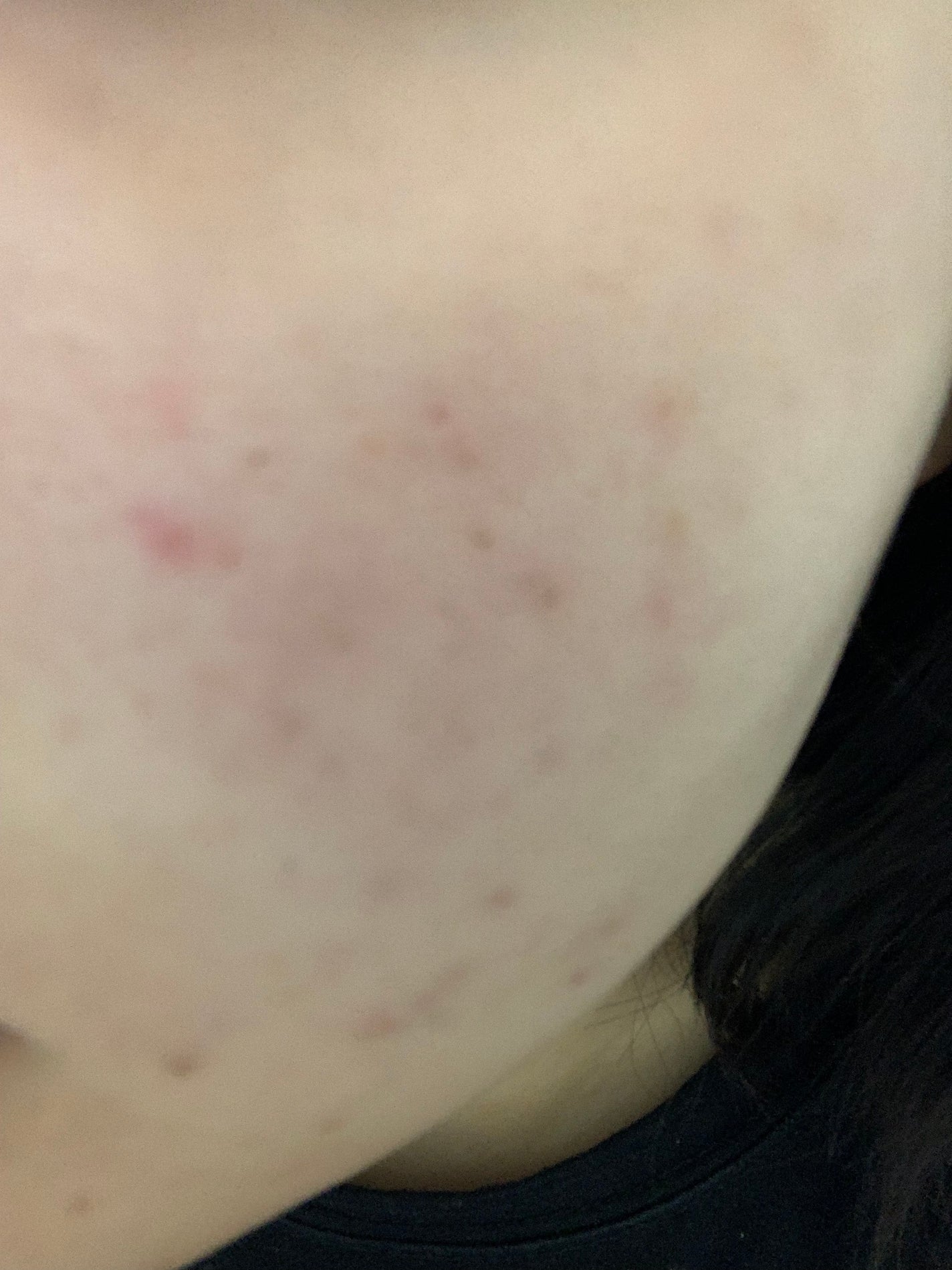 さく on LIPS 「今日のお肌✨やはりニキビ跡が気になる#JK#垢抜け #肌改善 ..」(2枚目)