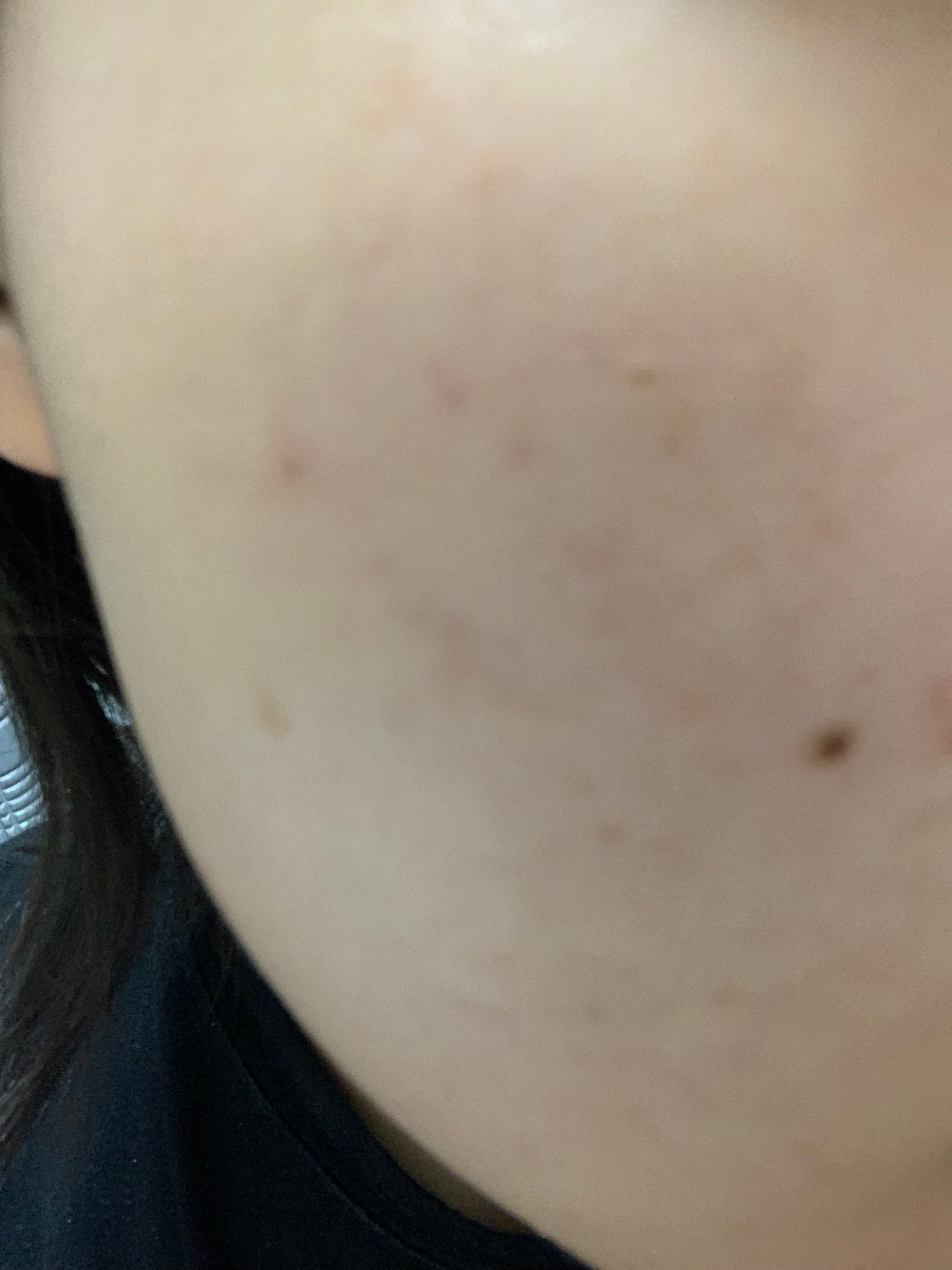 さく on LIPS 「今日のお肌✨やはりニキビ跡が気になる#JK#垢抜け #肌改善 ..」(3枚目)