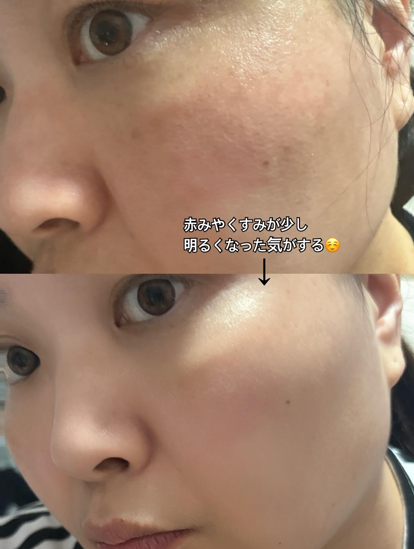 トラネキサム酸スキンブースタークリーム/MEDITHERAPY/フェイスクリームを使ったクチコミ（3枚目）