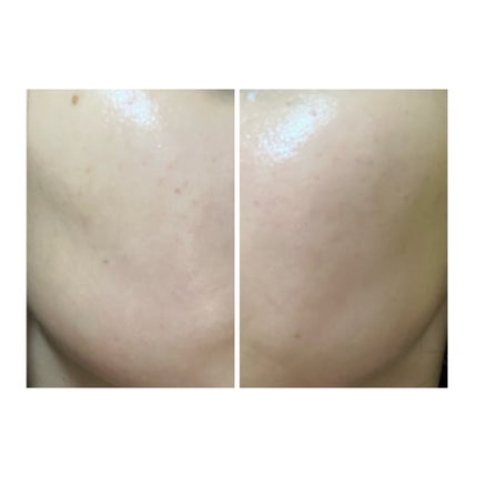 ぽむ on LIPS 「2023.9.13皮膚科に受診 エピデュオとヘパリン処方1枚目..」(5枚目)