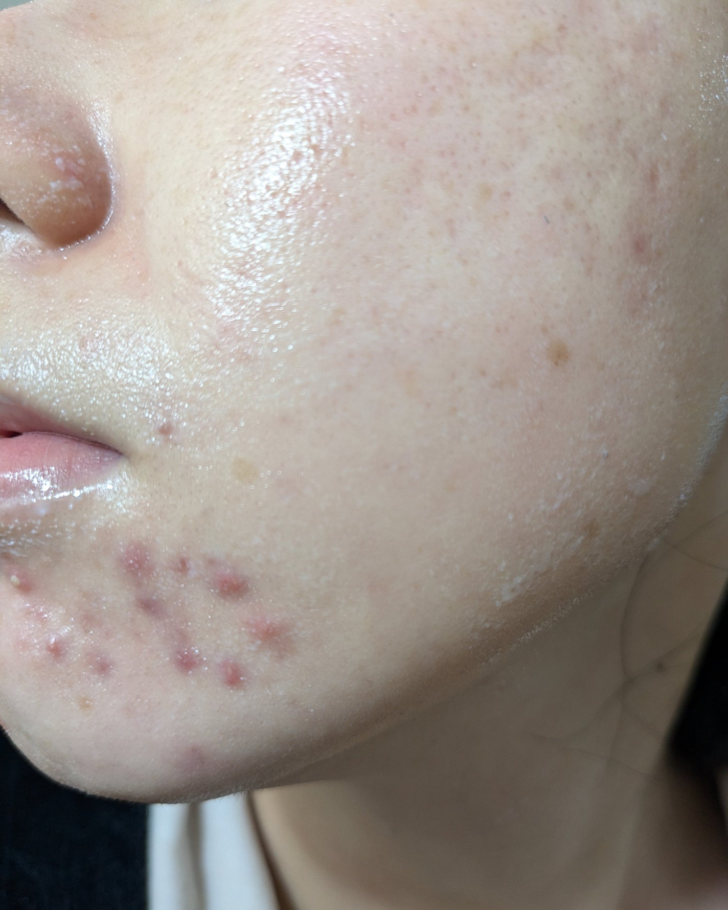 miina@汚肌工事録⚠️ on LIPS 「12/13-12/19の#汚肌工事録どんどん赤くなってます😂乾..」(8枚目)