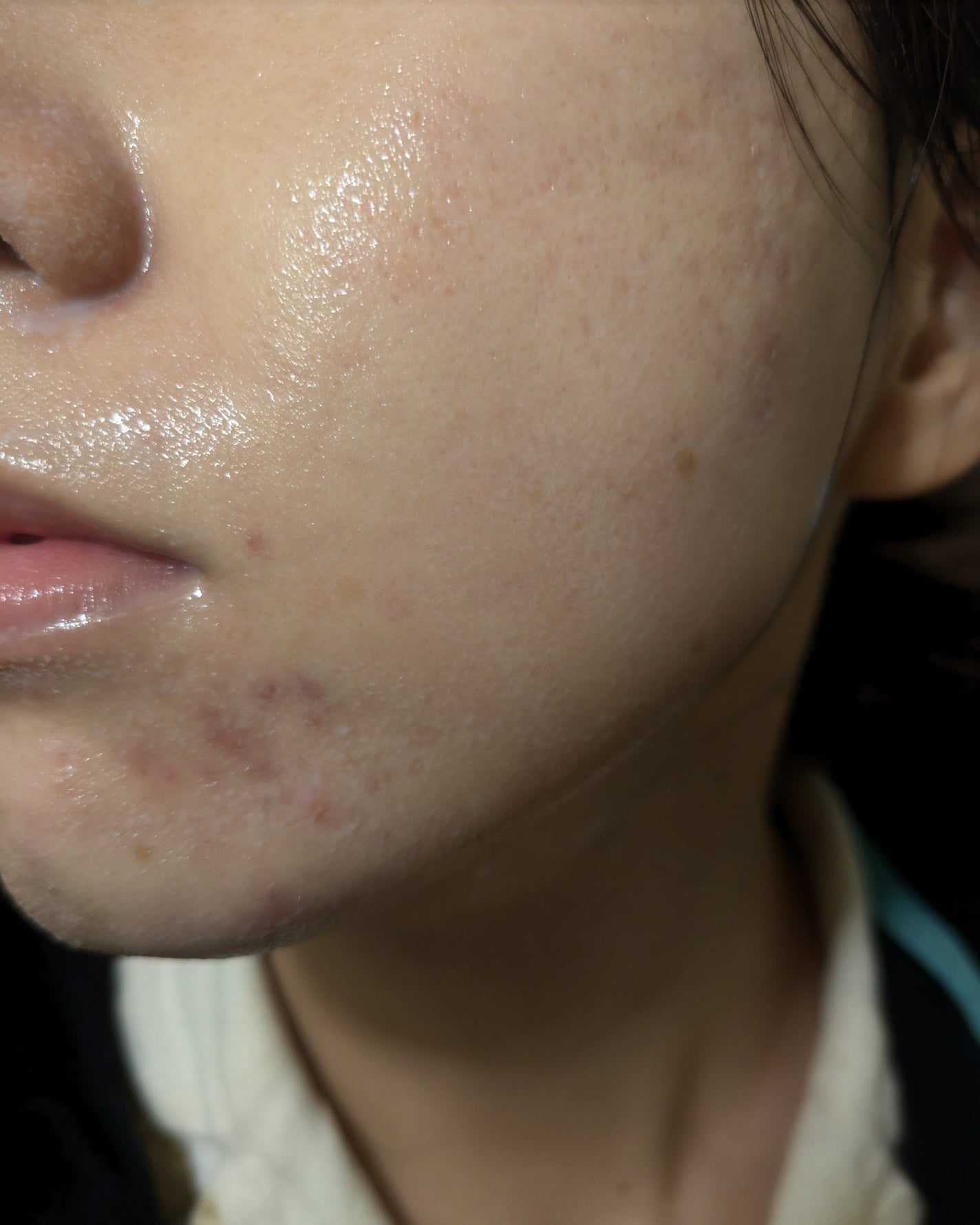 miina@汚肌工事録⚠️ on LIPS 「12/1-12/5の#汚肌工事録..」(6枚目)