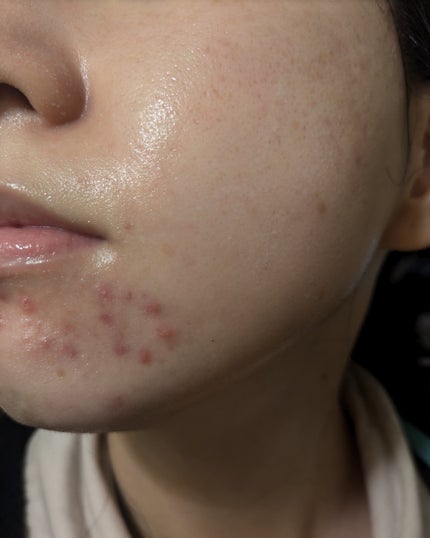 miina@汚肌工事録⚠️ on LIPS 「12/13-12/19の#汚肌工事録どんどん赤くなってます😂乾..」(10枚目)