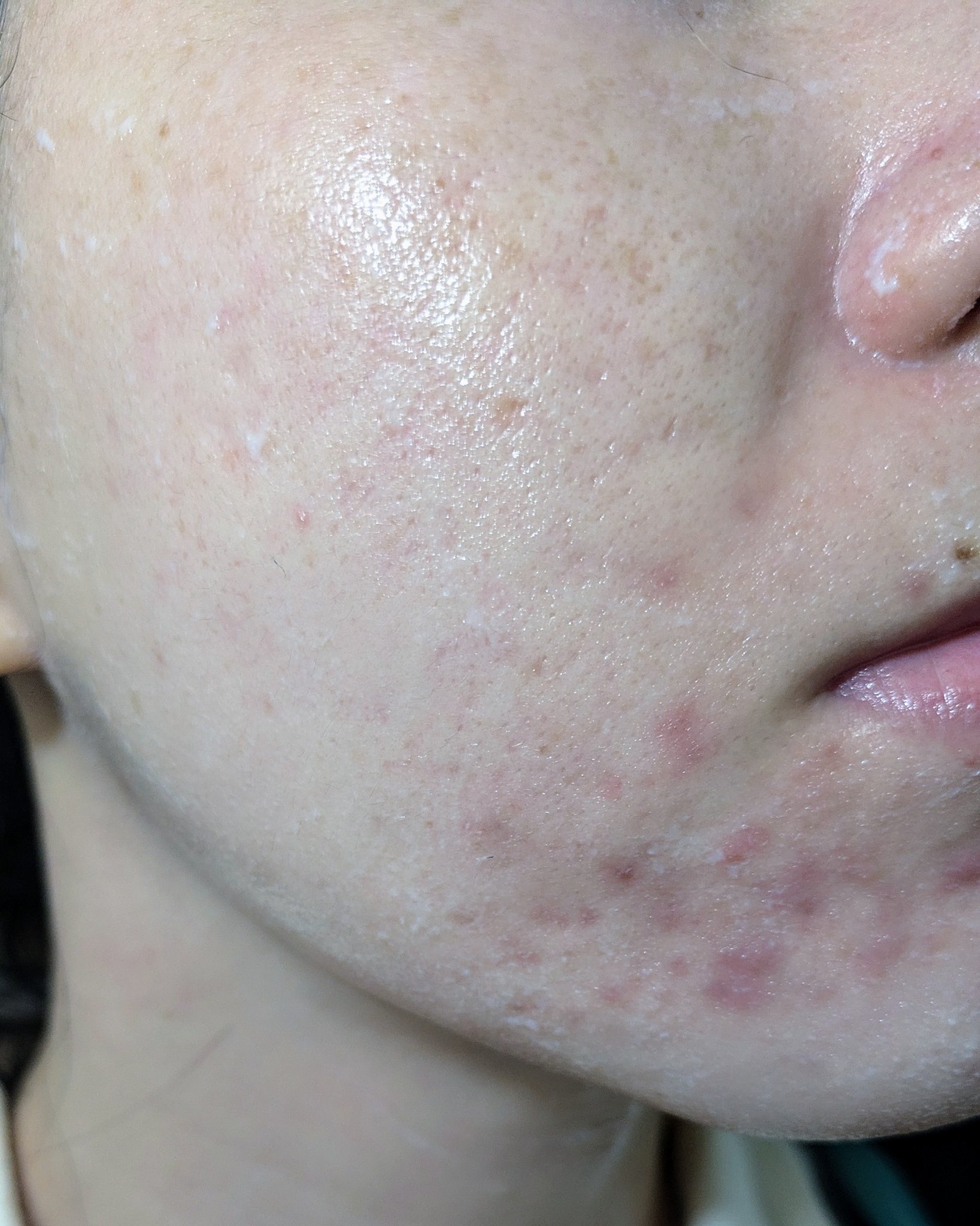 #汚肌工事録

11月後半の写真。ボコボコしててホントに手が追えなかった🥲
今引いてるのはほんとにキセキみたいだけど、季節的なものだったのかな…