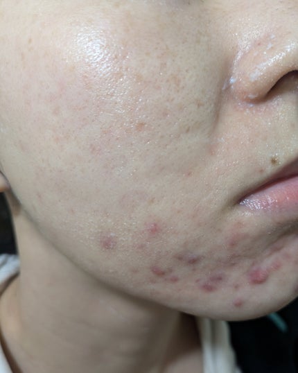 miina@汚肌工事録⚠️ on LIPS 「12/13-12/19の#汚肌工事録どんどん赤くなってます😂乾..」(7枚目)